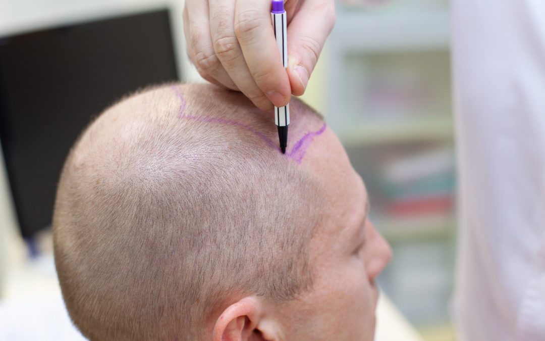 Transplantament Capil·lar